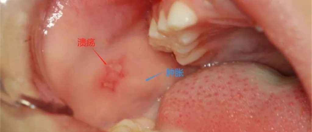 孩子出现口腔溃疡，这个原因你可能想不到