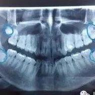 智齿到底该不该拔？作为牙医我坦诚实情！
